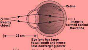 Science Class 10 Human Eye and Colourful World Hypermetropia